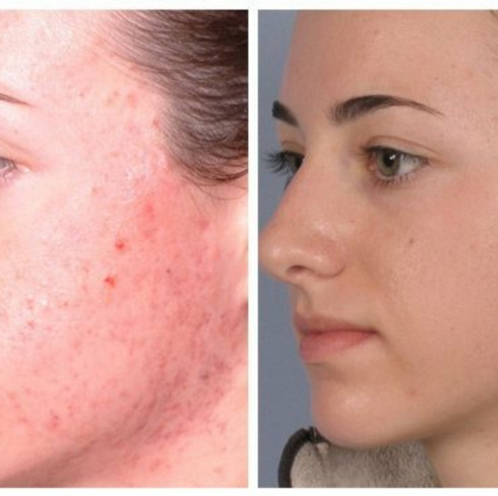 2 Bars Of Acne Removing Soap
